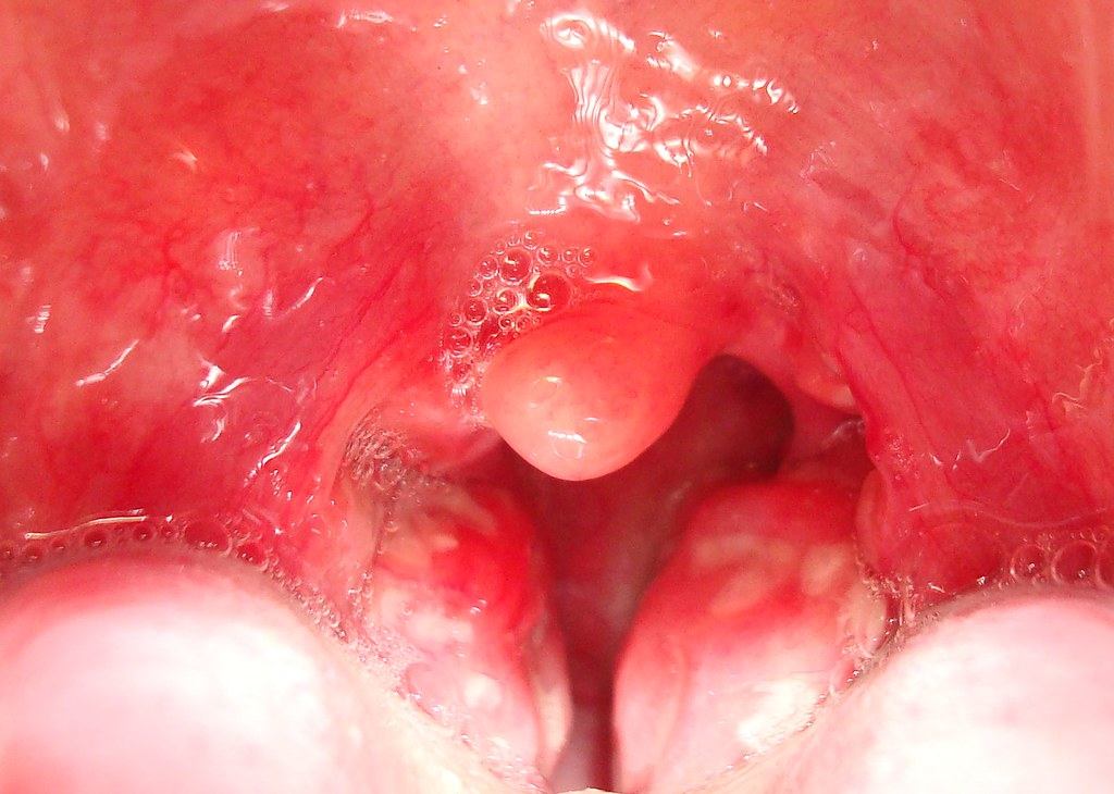 Tonsillitis: Symptoms, Treatment and When You Need Antibiotics